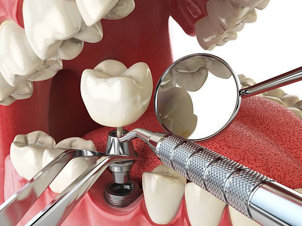 Best Emergency Treatment for Oral Infections in South Haven, MI
