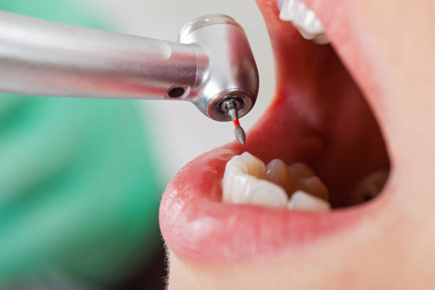 Best Lost Filling or Crown Replacement in South Haven, MI